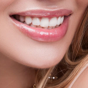 Woman smiling with veneers Woman smiling with veneers